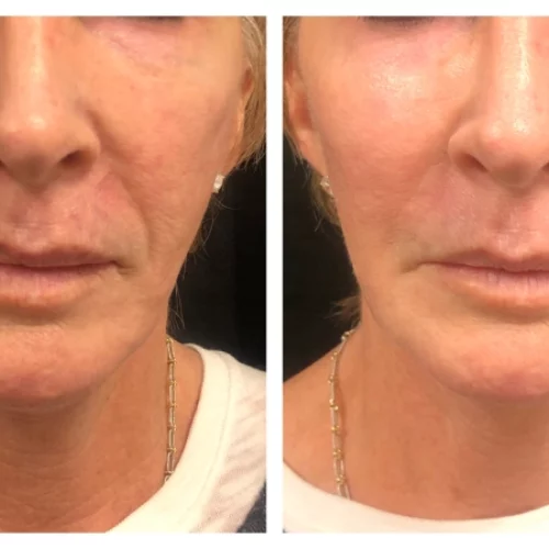 Lower Face Filler