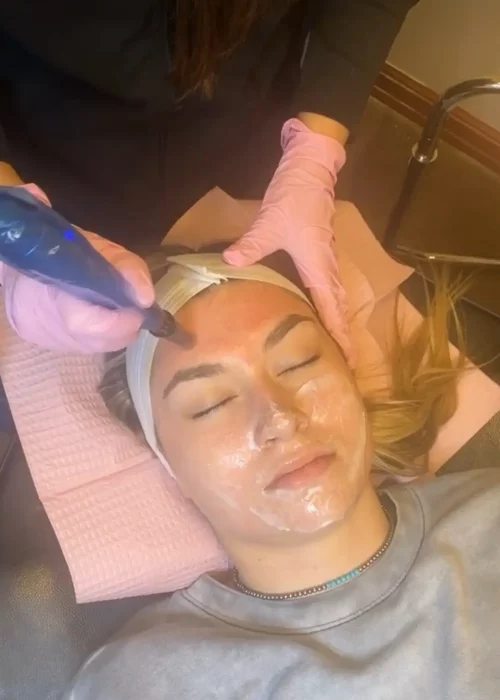 Microneedling Treatment