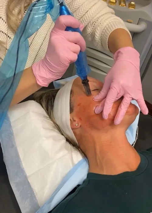 Microneedling Treatment