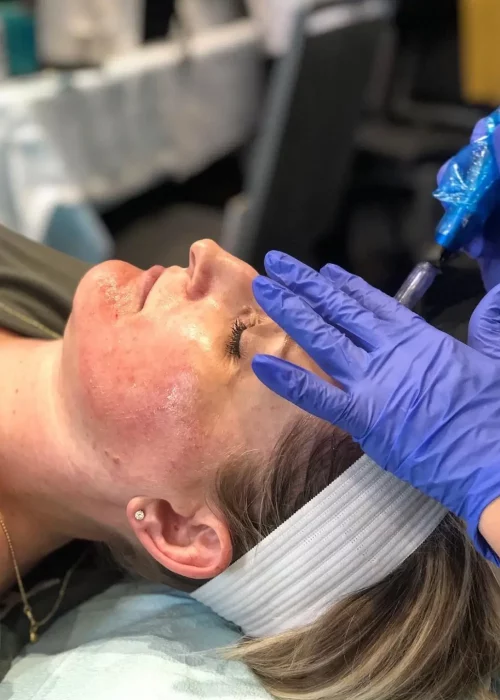 Microneedling Treatment