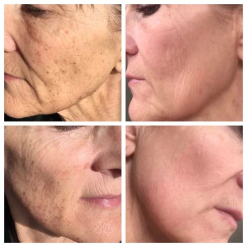 Sculpt Aesthetics Laser Before and after photos for BBL A in Meridian, Idaho