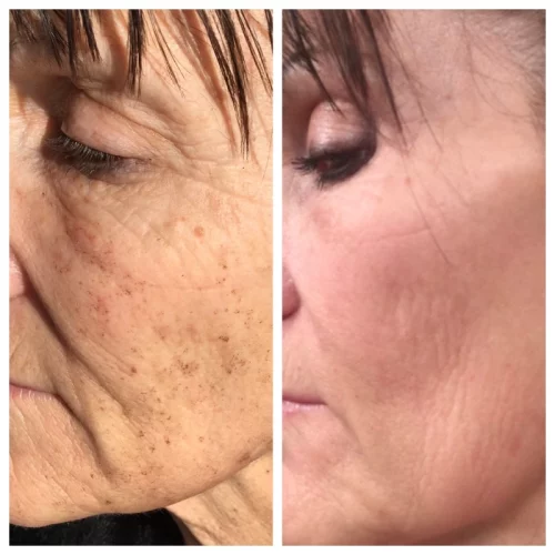 Sculpt Aesthetics Laser Before and after photos for BBL B in Meridian, Idaho