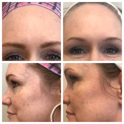 Sculpt Aesthetics Laser Before and after photos for BBL C in Meridian, Idaho