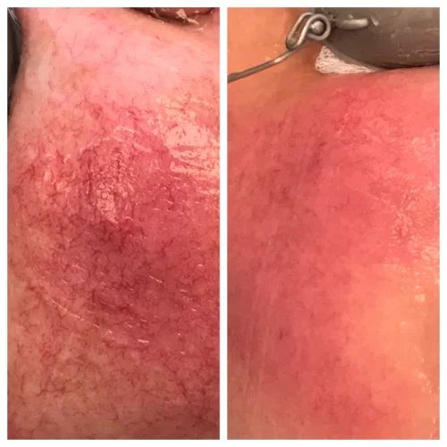 Sculpt Aesthetics Laser Before and after photos for BBL E in Meridian, Idaho