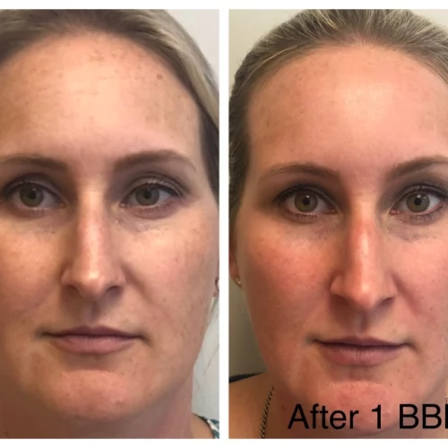 Sculpt Aesthetics Laser Before and after photos for BBL G in Meridian, Idaho