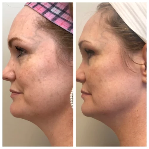 Sculpt Aesthetics Laser Before and after photos for BBL H in Meridian, Idaho